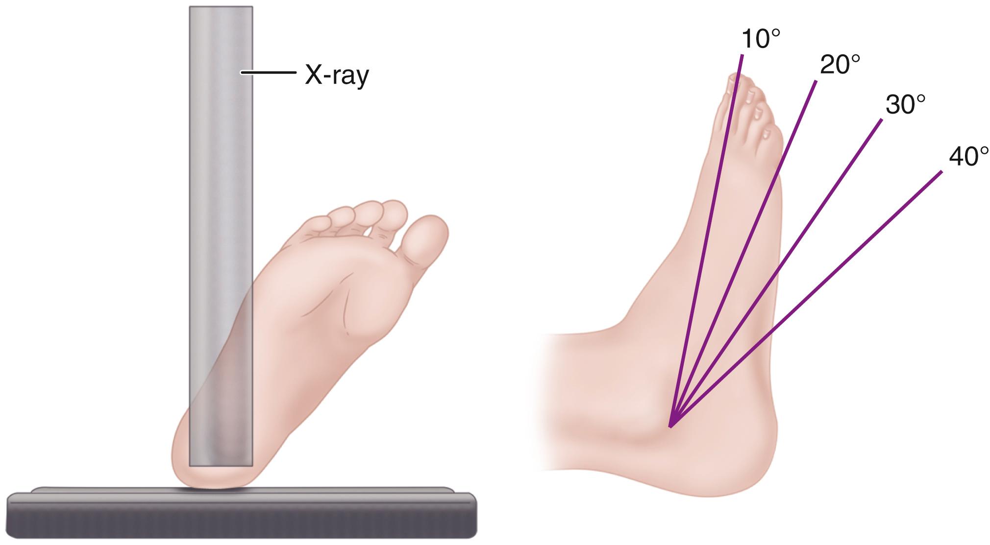 FIGURE 89.5, Brodén view. Three internal rotation views taken in 45 degrees of internal rotation with 10 to 40 degrees of radiographic tube angulation. External rotation view is taken at 45 degrees of external rotation and 30 degrees of radiographic tube angulation.