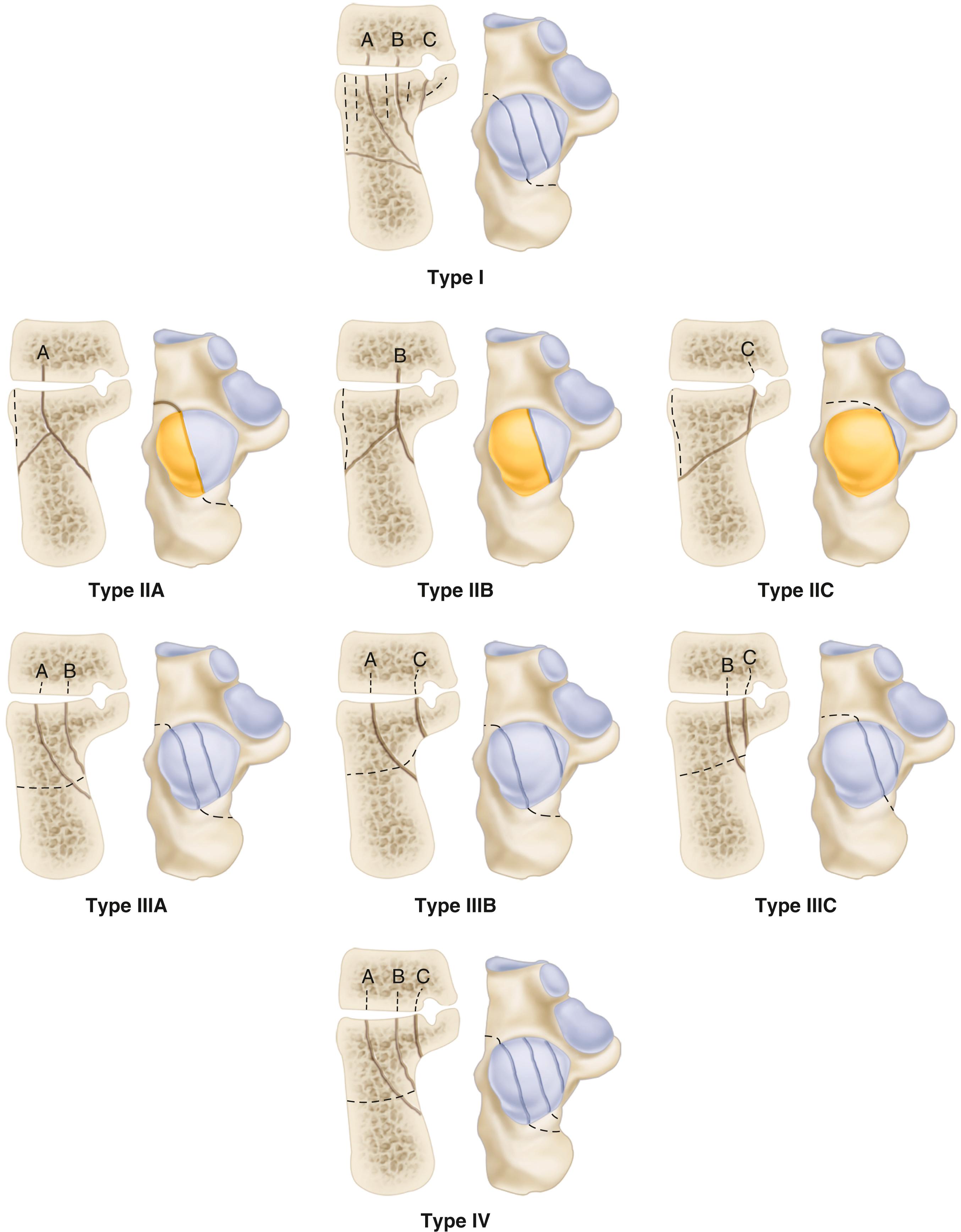 FIGURE 89.7, CT classification of intraarticular calcaneal fractures.