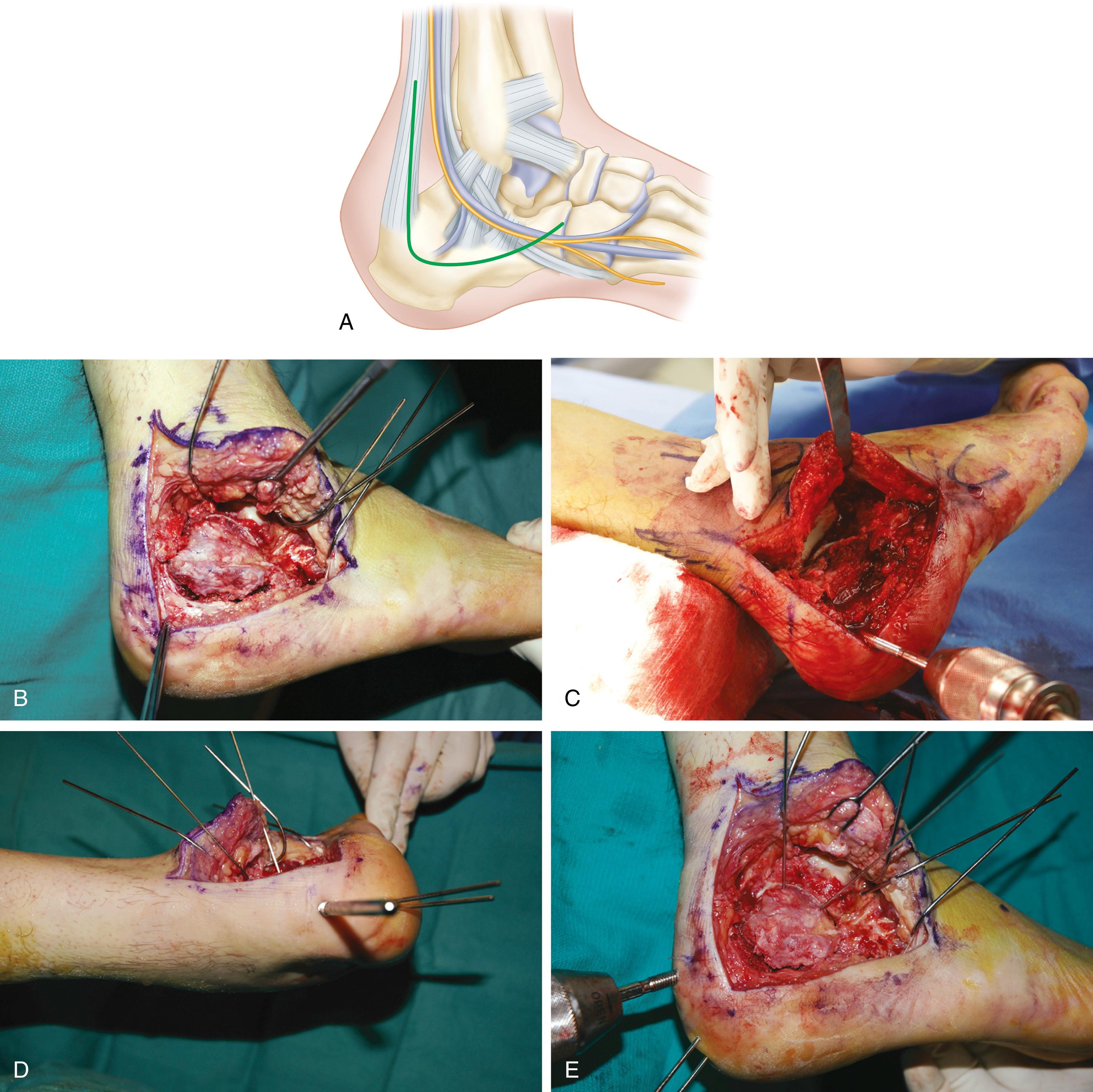 FIGURE 89.8, Open reduction of calcaneal fracture (see text). A, Incision. B, Retraction of full-thickness flap with Kirschner wires. C, Large pin used to manipulate tuberosity fragment. D, Provisional fixation from heel into sustentacular fragment. E, Reduction and provisional fixation of posterior facet. SEE TECHNIQUE 89.1.