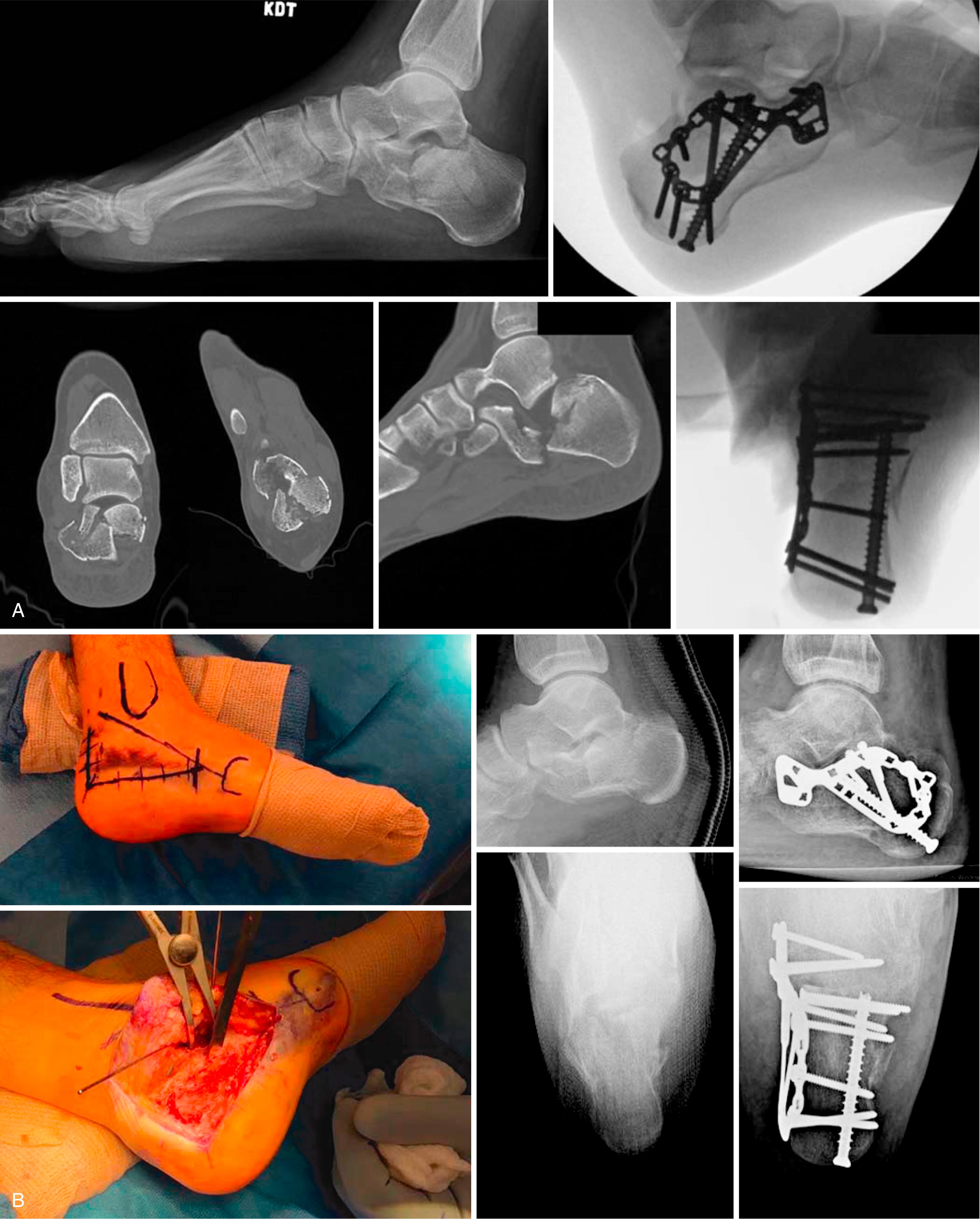 FIGURE 89.9, Lateral plate extending from anterior process of talus into most posterior aspect of tuberosity helps maintain neutral alignment of calcaneus. SEE TECHNIQUE 89.1.