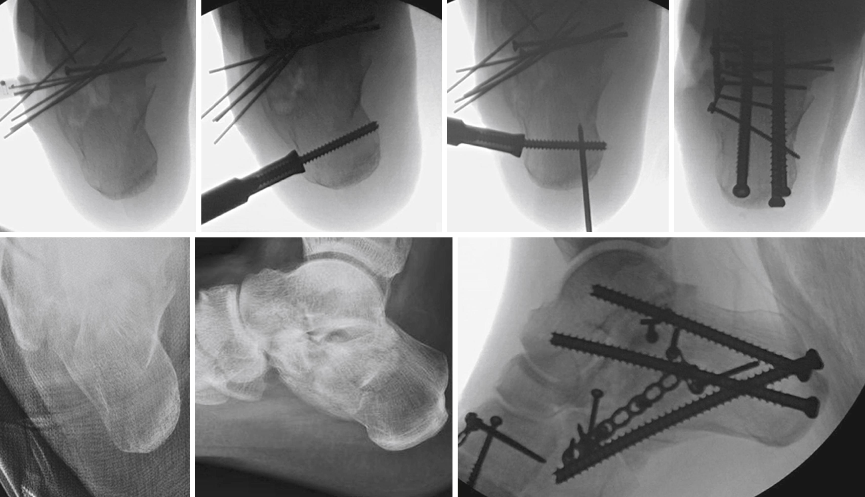 FIGURE 89.10, Subtalar arthrodesis for treatment of calcaneal fracture. Intraoperative correction of varus deformity with joystick along with fixation and double arthrodesis for comminuted calcaneal fracture. Fully threaded screws are used to maintain height of calcaneus. SEE TECHNIQUES 89.2 AND 89.3.