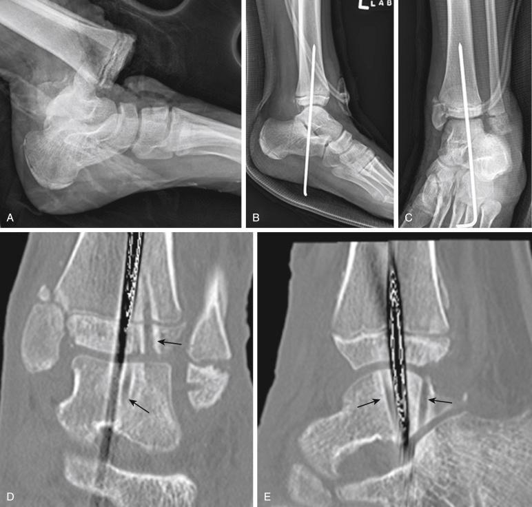 Fig. 15.11, (A) Open ankle fracture-dislocation in an 11-year-old girl following pedestrian versus car accident. (B and C) She was treated by open reduction and transarticular placement of Steinmann pin to maintain joint reduction and stability. (D and E) Computed tomography scan of the ankle. Multiple passes of the pin ( arrows ) through the articular surface and through the distal tibial physis should be avoided; an external fixator should be considered in such cases.