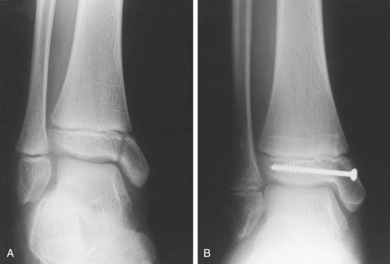 Fig. 15.12, Supination-inversion grade II. Salter-Harris type III fracture treated by a percutaneous interfragmentary screw. (A) In this adduction injury, the fracture occurred just above the superomedial aspect of the talar dome. The fracture line of the epiphysis ends at the physis. (B) The injury was treated by closed reduction and a percutaneous interfragmentary screw. Note the horizontal Park-Harris line, indicative of normal growth after treatment. The screw should never cross an open growth plate obliquely.