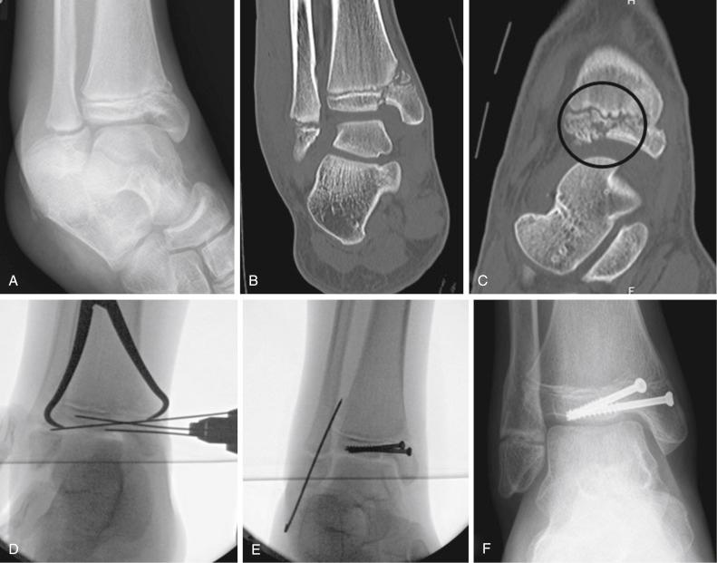 Fig. 15.13, (A) Salter-Harris type IV fracture of medial malleolus fracture in 14-year-old boy following fall off a trampoline. Coronal (B) and sagittal (C) computed tomography scan showing comminution of the fracture ( black circle ). (D) During open reduction and internal fixation, multiple K-wires were used to reconstruct the articular surface. (E) Raft screws were used to maintain the joint surface reduction, besides fixation of the medial malleolus fracture fragment. Fibula fracture fixation is optional but does add stability to fracture fixation. (F) Follow-up radiograph 1 year later shows well-healed fracture and intact articular surface.