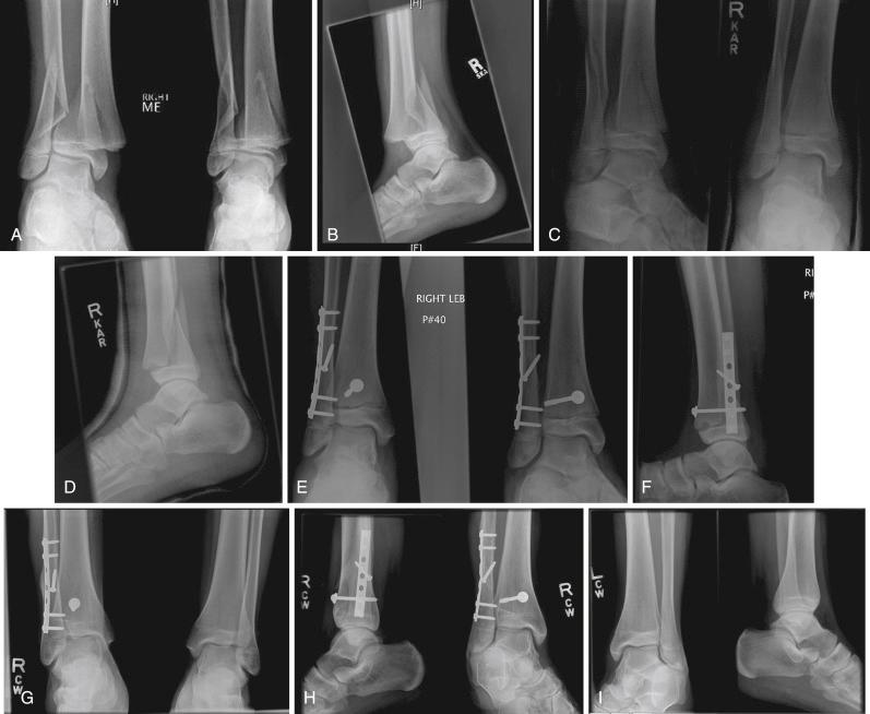 Fig. 15.14, Supination-external rotation fracture of the right ankle in a 14-year, 11-month male patient. (A) Initial mortise and anteroposterior views demonstrating fractures of the distal fibula and distal tibia (with a large medially based Thurston-Holland fragment). (B) Lateral injury radiograph illustrates anterodistal to posteroproximal orientation of the fibula fracture. (C and D) Unacceptable alignment on mortise, anteroposterior, and lateral views after effort at closed reduction. (E and F) Anatomic alignment after open reduction with internal fixation. (G, H, and I) Multiple views of both ankles at 1-year follow-up showing complete healing and fortuitous simultaneous closure of growth plates of both ankles.