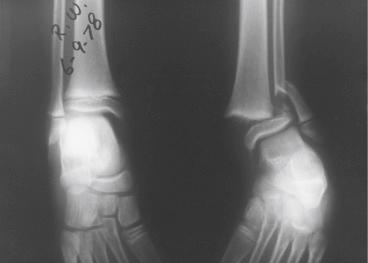 Fig. 15.15, Pronation-external rotation Salter-Harris type II fracture of the distal end of the tibia with a fibular shaft fracture. This Salter-Harris type II fracture is an abduction injury. The Thurston-Holland fragment sign on the distal end of the tibia is on the lateral aspect.