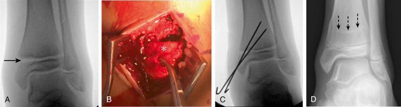 Fig. 15.16, A 13-year-old boy with pronation-eversion injury and Salter-Harris I fracture of distal tibial. (A) After closed reduction of fracture, there is persistent widening of the physis and valgus alignment at the fracture site. The patient underwent open reduction (B), removal of the interposed periosteum ( asterisk ) from the physis, and (C) internal fixation using smooth K-wires across the physis. The K-wires were removed at 4 weeks postoperative in the clinic. At 2 years’ follow-up (D), a symmetric Park-Harris line ( dashed arrows ), parallel to the physis, indicates normal growth.