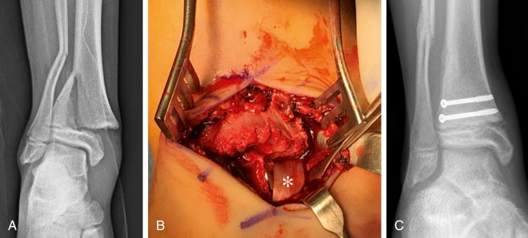 Fig. 15.17, (A) A 14-year-old with pronation-eversion fracture with Salter-Harris type II fracture of tibia following a basketball injury. The fracture was irreducible under general anesthesia. (B) A medial approach was performed and the interposed tibialis posterior tendon ( asterisk ) was removed, allowing for fracture reduction. (C) The large metaphyseal fragment allowed for placement of two cannulated screws for fracture fixation. Once reduced, the guide wires for fracture fixation were placed from medial to lateral through the exposed fracture site, and cannulated screws were then placed percutaneously from lateral to medial direction.