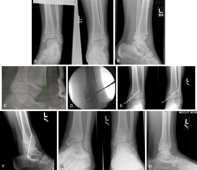 Fig. 15.18, Supination-plantar flexion fracture of the left ankle in a 13-year, 1-month male patient. (A) Initial mortise and anteroposterior views that demonstrate an intact fibula, physeal widening of the distal tibia, and presence of a Thurston-Holland fragment. (B) Lateral radiograph demonstrates posteriorly translated Salter-Harris II fracture with a posteriorly oriented Thurston-Holland fragment. (C) Displacement of almost 6 mm remains after closed reduction. (D) Open reduction included gentle removal of interposed periosteum. (E) Postoperative mortise and anteroposterior radiographs show smooth K-wire fixation just before pin removal at 4 weeks. (F) Postoperative lateral radiograph showing anatomic reduction. (G) One-year follow-up mortise and anteroposterior radiographs showing symmetric Park-Harris line. (H) A 1-year follow-up lateral view also showing a “good” Park-Harris line.