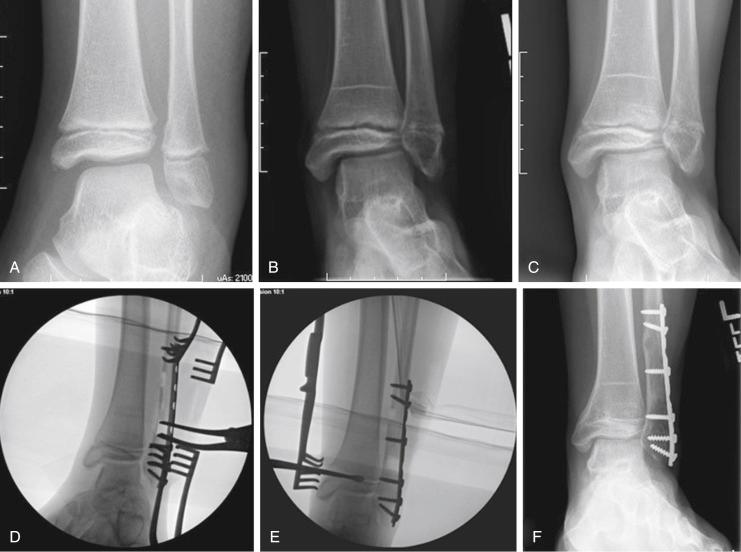 Fig. 15.19, Salter-Harris type V fracture of the distal fibula. (A) There was no apparent fibular physeal abnormality on x-ray at time of injury for this 8-year-old girl. (B) Follow-up x-ray 2 years later (asymptomatic) shows physeal arrest of fibula and normal Park-Harris line of distal tibia. (C) A year later (3 years after injury), she is still asymptomatic, but there is a resulting angular deformity of the ankle from fibular growth arrest from presumed type V physeal injury and continued distal tibial growth. (D and E) Intraoperative fluoroscopy showing fibular lengthening osteotomy with fixation (and correction of ankle angular deformity) and distal tibial epiphysiodesis. (F) One-year follow-up from osteotomy/epiphysiodesis with healed fibular osteotomy and maintenance of angular correction.