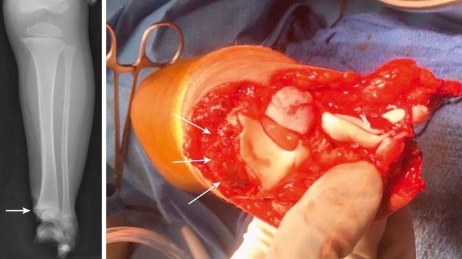 Fig. 15.20, Radiograph of type VI distal tibia fracture resulting from a lawn mower injury in a 3-year-old boy, and the correlating clinical photo showing the axial view of the distal tibia articular surface with the medial malleolus sheared off through the physis ( white arrows ).
