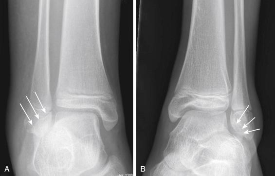 Fig. 15.21, (A) Sharp fracture edges ( arrows ) of type VII fracture of the distal fibular epiphysis. (B) Well-rounded ossicle at the inferior aspect of the distal fibula ( arrows ) indicating os subfibulare.