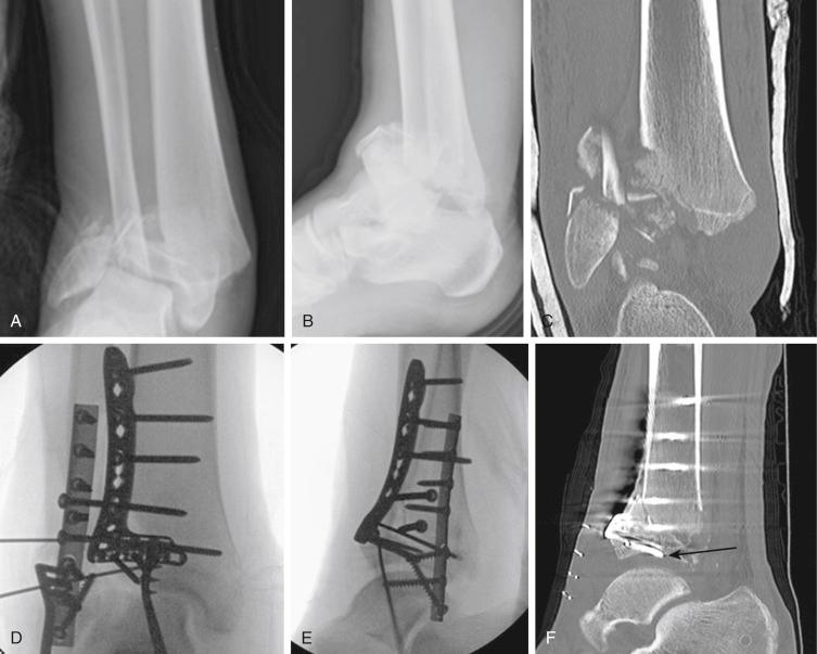 Fig. 15.22, A 17-year-old boy with closing physis, who sustained a pilon fracture of the distal tibia (A and B) when he jumped over a fence and landed on a rock. The computed tomography (CT) scan (C) demonstrates comminution in the epiphysis. (D and E) His initial treatment involved external fixation. Once the swelling subsided, he underwent definitive treatment with open reduction and internal fixation. Postoperative CT scan (F) shows the tip of the screw violating the articular surface ( arrow ). The intraoperative fluoroscopy image (E) can underestimate the position of the hardware.