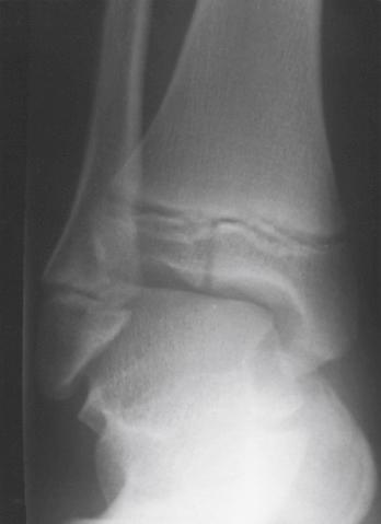 Fig. 15.23, This nondisplaced Salter-Harris type III fracture was treated by cast immobilization with an uneventful outcome.