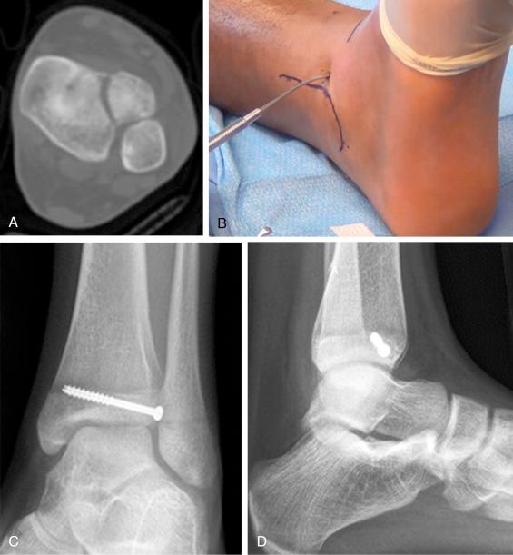 Fig. 15.24, Axial computed tomography scan (A) through the epiphysis shows the anterolateral Tillaux fracture with its typical fracture line. (B) Percutaneous fixation performed by insertion of screw in the epiphysis, starting just anterior to the anterior aspect of fibula. (C and D) The screw can be inserted obliquely through the physis, as the medial aspect of the physis is already closed.