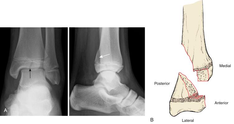 Fig. 15.25, Typical radiographic appearance of triplane fracture. (A) On anteroposterior view, the fracture ( black arrow ) appears to be a Salter-Harris type III fracture, similar to Tillaux fracture. (B) On lateral view, the posterior metaphyseal fracture ( white arrow ) appears to be a Salter-Harris type II fracture of distal tibia. The fracture actually represents a Salter-Harris type IV fracture of distal tibia. (B) Artist’s rendition of a two-fragment triplane fracture.