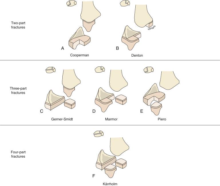 Fig. 15.26, Hierarchy of triplane fractures (with eponyms). (A) Tillaux position contiguous with Salter-Harris IV position and medial malleolus intact. (B) Medial malleolus position contiguous with Salter-Harris IV position and Tillaux segment intact. (C) Medial malleolus intact. (D) Tillaux fragment disrupted, plus Denton-type fragment. (E) Free fragment medial malleolus. (F) Medial malleolus, Salter-Harris IV, and Tillaux fragments are all present.