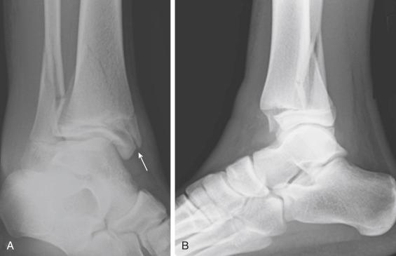 Fig. 15.27, Anteroposterior (A) and lateral (B) radiograph of an extraarticular triplane fracture. On the lateral view, the fracture may appear to be similar to an intraarticular triplane fracture, but on the anteroposterior view, the fracture exits through the medial malleolus ( arrow ) instead of the joint surface.