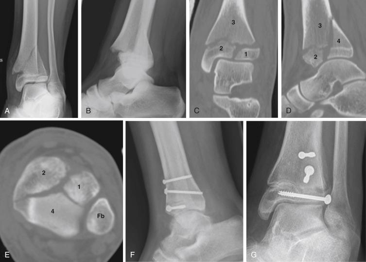 Fig. 15.28, (A and B) Radiographs of triplane fracture. Computed tomography scan imaging in coronal (C), sagittal (D), and epiphyseal axial (E) plane show a four-part triplane fracture. All four fracture parts are numbered. Typical percutaneous fixation of triplane fracture involves lateral to medial epiphyseal screw and anterior to posterior metaphyseal screw, as shown on postoperative lateral (F) and anteroposterior (G) radiographs. Fb, Fibula.