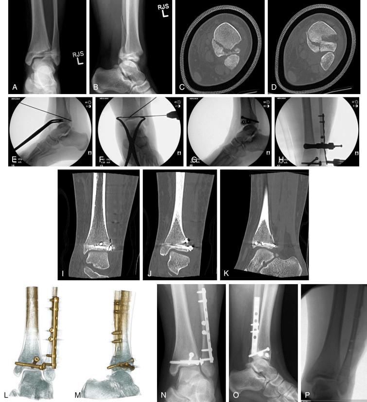 Fig. 15.29, A 13-year, 4-month female patient (approaching skeletal maturity) who sustained a displaced three-part triplane fracture with associated fibular fracture of her left ankle. (A) Mortise view clearly demonstrating displaced anterolateral fragment (Tillaux fragment). (B) Lateral radiograph illustrating comminuted distal tibial epiphysis and associated oblique fibular fracture. (C) A computed tomography (CT) scan cut above the physis illustrating posteriorly located Thurston-Holland fragment. (D) CT scan below the physis demonstrating the so-called Mercedes sign, which confirms the free Tillaux fragment. (E through H) Selected fluoroscopic images illustrating the sequence of fracture fragment fixation and reduction tactics. (I through K) Postoperative two-dimensional CT imaging. (L and M) Postoperative three-dimensional CT imaging. (N and O) Six-month follow-up plain radiographs. (P) All implants removed and growth plates clearly closed at 1-year anniversary.