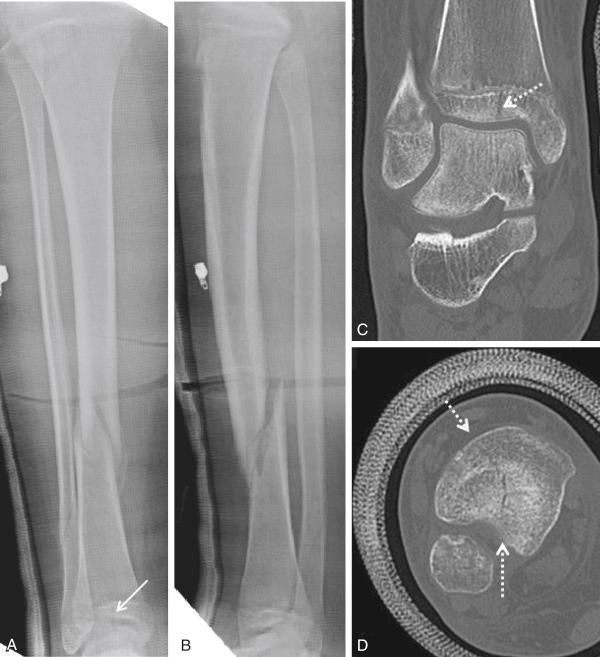 Fig. 15.30, Anteroposterior (A) and lateral (B) radiographs taken at 1-month follow-up for tibial-fibular shaft fracture in a 14-year-old boy. The triplane ankle fracture ( arrow ) is seen; it was initially missed. The coronal (C) and axial (D) computed tomographic scans show that the ankle triplane fracture was not displaced (<2 mm of displacement), and the fracture was healing ( dashed arrows ) . Conservative treatment was continued, and the patient had a satisfactory outcome.