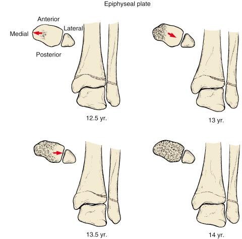 Fig. 15.3, Average age of onset and normal fusion pattern in the distal tibial epiphysis.