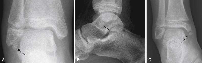 Fig. 15.4, (A and B) Os subfibulare ( black arrows ) at the distal aspect of fibula. (C) Os subtibiale ( black dashed arrow ) distal to medial malleolus. These well-rounded and well-corticated ossicles represent ossification variants or remote injuries and may be confused as acute fractures.