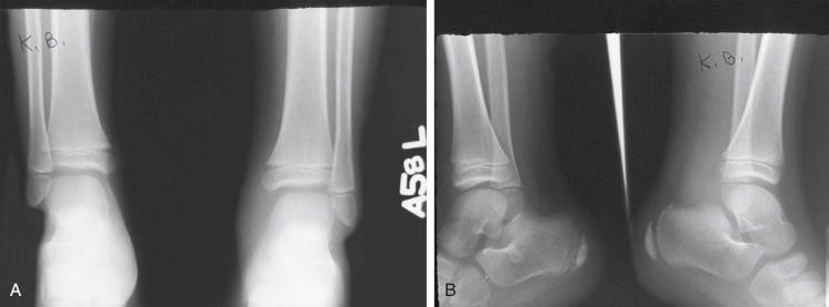 Fig. 15.5, Radiographic evaluation of the foot with notation of the fat stripe (soft tissue shadows) . (A) The right side is normal. Note the increase in soft tissue density adjacent to and below the medial malleolus on the left side. (B) The left lateral ankle view (right side) shows an increase in the soft tissue posterior to the ankle joint. The soft tissue density is limited by the fat stripe just anterior to the Achilles tendon shadow.