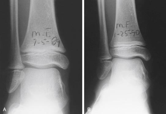 Fig. 15.6, “Sprain” injury to the ankle, with the subsequent development of Park-Harris lines. (A) A radiograph taken at the time of injury demonstrates soft tissue swelling below the malleoli. (B) Six months later, a horizontal line is seen just superior to the physis of both the tibia and fibula—the Park-Harris growth arrest line. The line should always be horizontal and parallel to the physis when growth is normal.