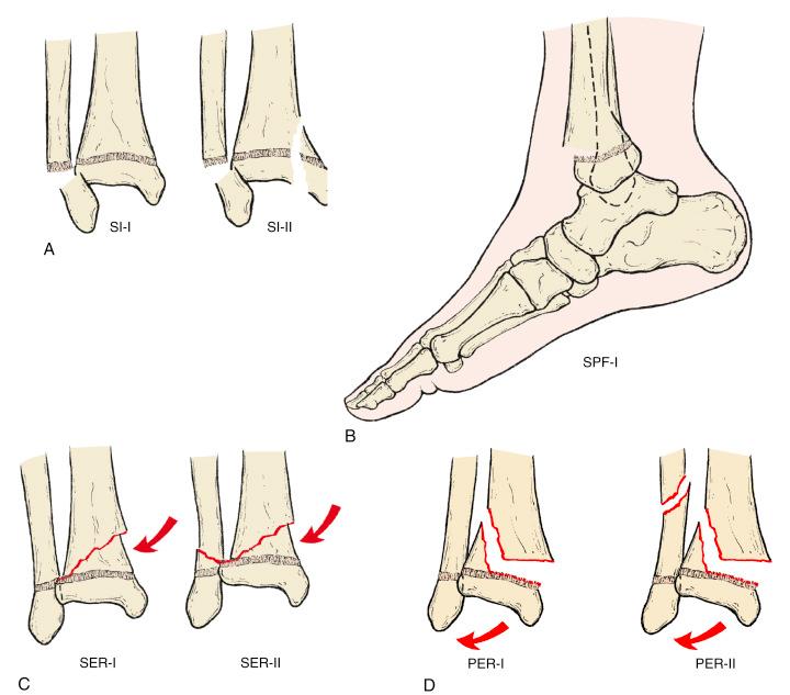 Fig. 15.7, (A) Supination-inversion ( SI ). (B) Supination-plantar flexion ( SPF ). (C) Supination-external rotation ( SER ). (D) Supination-external rotation ( PER ).