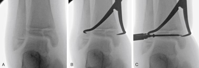 Fig. 15.9, (A) Tillaux fracture. (B) Indirect reduction using pointed reduction clamp placed percutaneously on medial malleolus and just anterior to the fibula. (C) Partially threaded cancellous screw with threads across the fracture site would allow for further fracture compression.