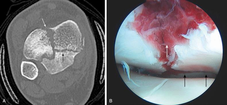 Fig. 15.10, The anterior gap ( white arrow ) on the computed tomography scan (A) and arthroscopic evaluation (B) is correlated. Similarly, the undisplaced posterior fracture line ( black arrows ) can be verified through ankle arthroscopy. During percutaneous fracture fixation for intraarticular fractures, arthroscope or arthrogram can be used to confirm the articular surface reduction.