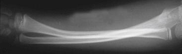 Fig. 18.1, Lateral radiograph of a plastic deformation fracture of the forearm. This degree of deformation often results in a cosmetic serpentine appearance and a mechanical block to forearm rotation. Forceful closed reduction under anesthesia is necessary for realignment.