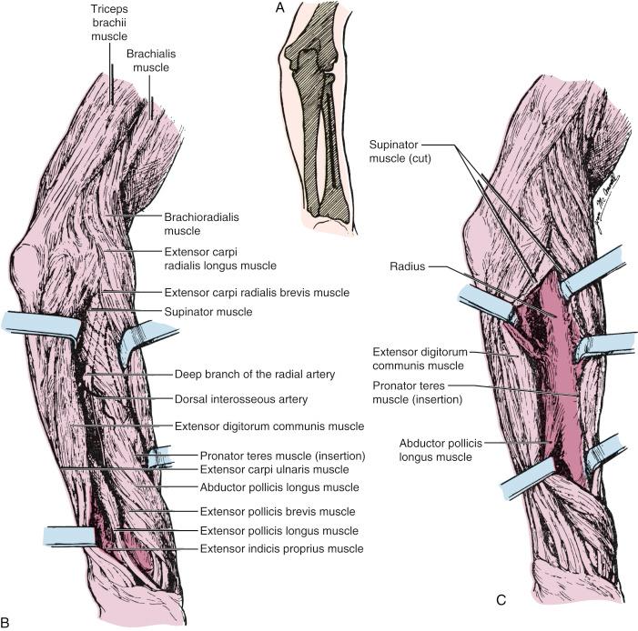 Fig. 18.11, Posterior approach to the radius (Thompson approach). (A) Skin incision along a line from the lateral epicondyle of the humerus to the Lister tubercle on the dorsal aspect of the radius. (B) The fascia is incised between the extensor radialis brevis and extensor digitorum communis. The abductor pollicis and extensor pollicis brevis cross the plane of dissection in the distal third. (C) The radius is exposed by reflecting the abductor pollicis longus and extensor pollicis brevis.