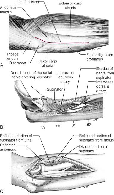 Fig. 18.12, The Boyd approach. (A) Line of the incision. (B) Pathway of the radial nerve. (C) Complete exposure of the upper third of the ulna, upper fourth of the radius, and radiohumeral articulation.