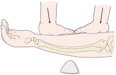 Fig. 18.2, Method of reducing plastic deformity of the forearm.