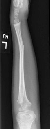 Fig. 18.3, Lateral radiograph of a diaphyseal forearm fracture with an apex volar supination deformity in a young child. Treatment is usually by closed reduction and initial long arm cast immobilization under conscious sedation in the emergency department.