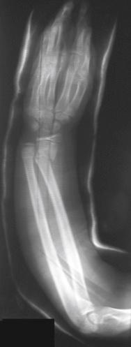 Fig. 18.5, Note the “banana cast” in this radiograph without a straight ulnar border, appropriate interosseous mold, and distal humeral mold in this long arm cast. As a consequence, there is loss of reduction of the fracture.