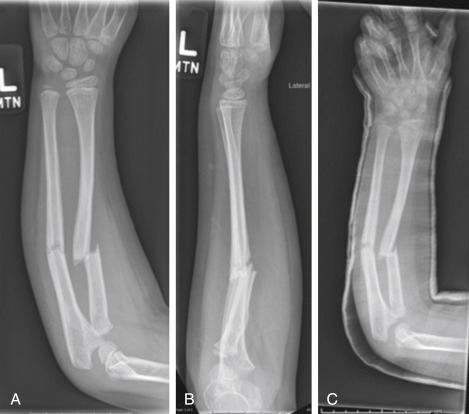 Fig. 18.7, Anteroposterior (A) and lateral (B) radiographs of a complete diaphyseal forearm fracture in a 7-year-old patient. There is overlap of the fracture fragments. Attempted closed reduction with long arm cast immobilization (C) reveals pending malunion. The loss of radial bow proximally will be a problem if not corrected. Current practice is to treat this type of fracture with internal fixation.