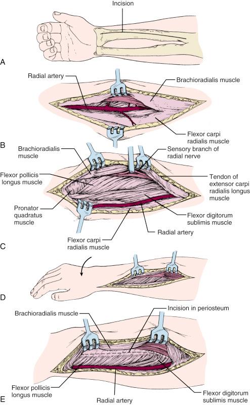 Fig. 18.8, Anterior approach to the radius (Henry approach). (A) Skin incision. (B) Fascia is incised. Brachioradialis is retracted laterally and flexor carpi radialis medially. (C) Sensory branch of the radial nerve is within the fascia, beneath the brachioradialis. These are retracted together laterally. The radial artery deep to the brachioradialis is mobilized and retracted medially, along with the flexor carpi radialis. This exposes the flexor pollicis longus, the flexor digitorum sublimis, and distally, the pronator quadratus. (D) The forearm is pronated to expose the radius lateral to the origins of the pronator quadratus and flexor pollicis longus. (E) Periosteum is incised along the broken line, and the flexor pollicis longus and pronator quadratus are reflected by subperiosteal dissection.