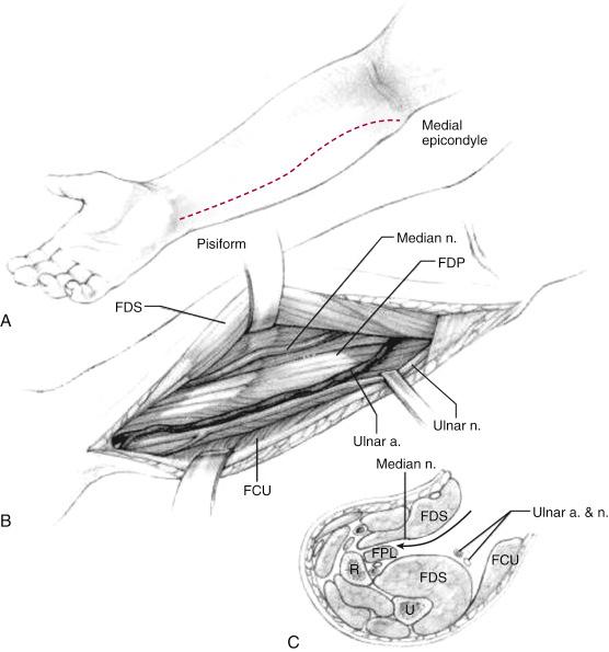 Fig. 18.10, The McConnell approach to the median nerve. (A) Incision. (B and C) The space between the flexor digitorum superficialis (FDS) and flexor carpi ulnaris (FCU) is used to expose the median nerve, which travels as a “satellite” on the undersurface of the FDS. This approach also provides excellent exposure of the ulnar nerve and artery. FDP, Flexor digitorum profundus; FPL, flexor pollicis longus; R, radius; U, ulna.