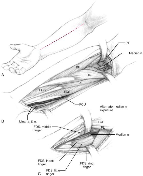 Fig. 18.9, Approach to the median and ulnar nerves. (A) Incision. (B) Proximal exposure of the median nerve is in the interval between the pronator teres (PT) and the flexor carpi radialis (FCR) . This space may be most easily identified at their distal zone of separation. The ulnar nerve is found in the space between the flexor digitorum superficialis (FDS) of the little finger and the flexor carpi ulnaris (FCU) . (C) The distal aspect of the median nerve may be identified beneath the FDS to the middle finger and in the space between the FDS of the middle and ring fingers. BR, Brachioradialis; PL, pollicis longus.