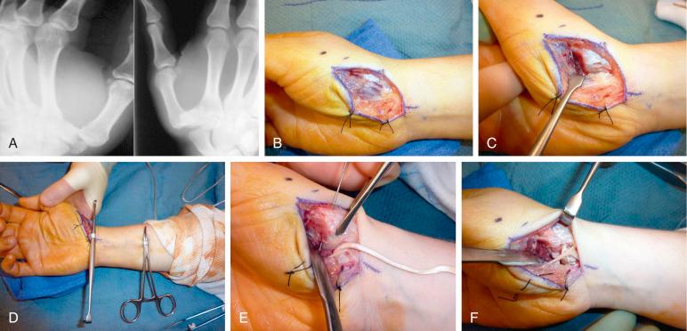 Fig. 40.11, (A) Thumb trapeziometacarpal dislocation with associated trapezial body fracture. (B) Anterior oblique ligament reconstruction is performed using the volar-radial Wagner exposure. (C) The thenar musculature is elevated from the volar carpometacarpal (CMC) capsule. (D) The flexor carpi radialis is harvested to reconstruct the anterior oblique and dorsal radial ligamentous complex. (E) The distally based autograft is passed through a volar-to-dorsal subchondral intraosseous channel. (F) The graft is then secured to the dorsal periosteum, passed deep to the abductor pollicis longus (APL) and secured to the dorsal capsule, weaved through the ulnar one-half of the flexor carpi radialis (FCR), and then secured back to the radial capsule.