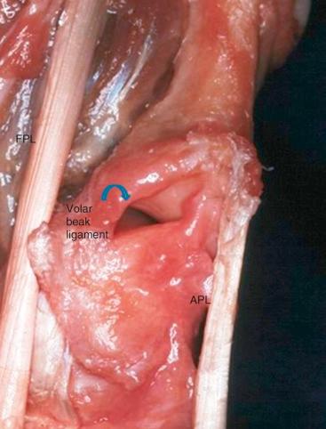 Fig. 40.3, The volar oblique ligament is stout originating from the trapezium and inserting onto the volar beak of the thumb metacarpal. It resists dorsoradial subluxation. APL, Abductor pollicis longus; FPL, flexor pollicis longus.