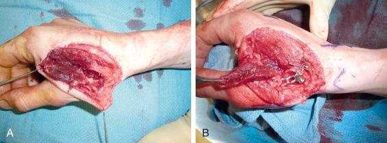 Fig. 40.5, (A) Partial thumb amputation at the level of the carpometacarpal (CMC) joint was sustained in a construction site accident. Lacerations of the extensor pollicis longus (EPL), extensor pollicis brevis (EPB), and the radial sensory nerve were repaired after open reduction and internal fixation (ORIF) of the underlying metaphyseal thumb metacarpal fracture. (B) Stable internal fixation with a fixed-angle implant allowed for early functional rehabilitation of this combined injury, using dynamic extension splinting.