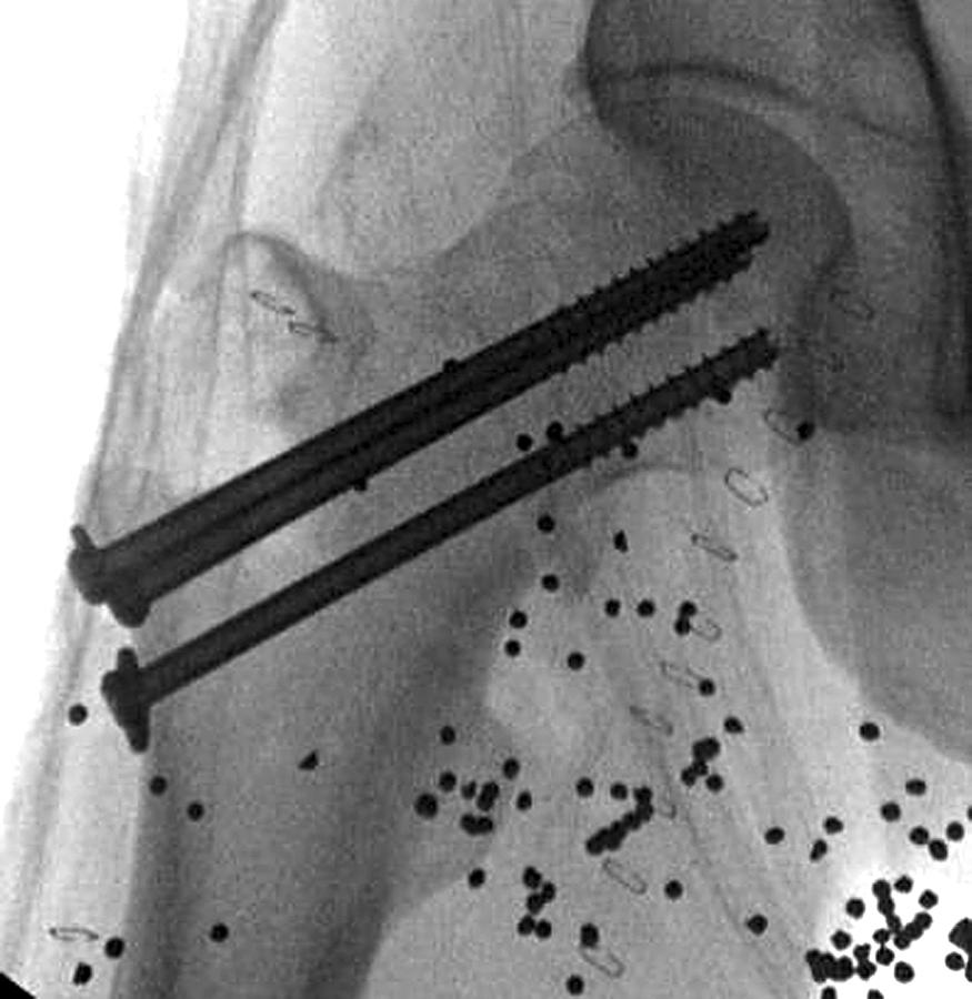 FIGURE 55.13, Cannulated screw fixation of displaced femoral neck fracture after open reduction.