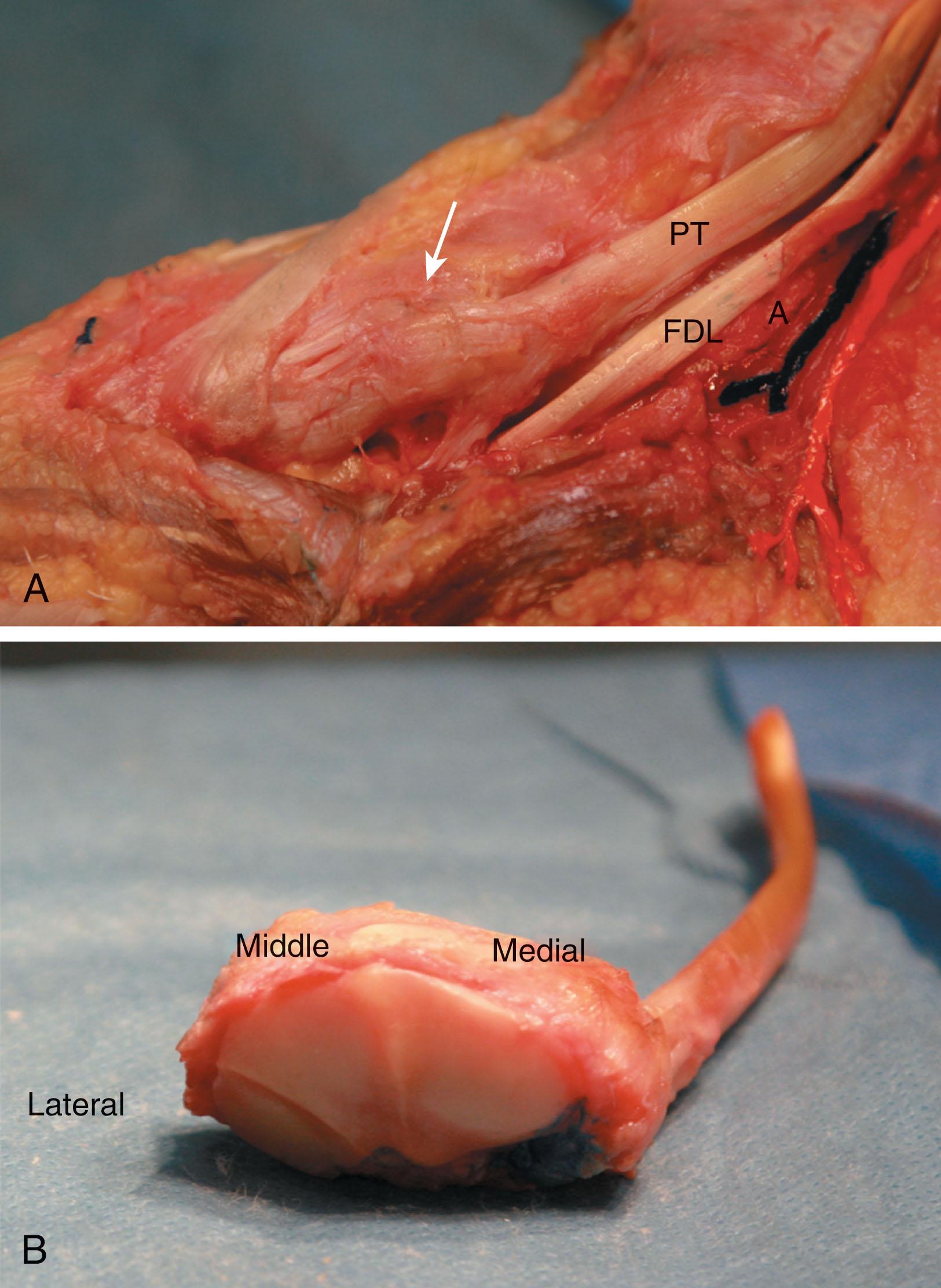 Fig. 47-1, A , Clinical photograph of a cadaveric midfoot specimen. PT denotes the posterior tibial tendon, FDL the flexor digitorum longus, and A the posterior tibial artery; the blue stain denotes the posterior tibial vein and the orange stain the posterior tibial nerve and its proximal branches. The confluence of the anterior division of the deltoid and the dorsal talonavicular ligaments that join to form the tibionavicular ligament is marked with an arrow . B , A clinical photograph of the distal end of a cadaveric navicular, with the cartilaginous articulations between the navicular and the medial, middle, and lateral cuneiforms labeled. The posterior tibial tendon remains attached at its insertion.