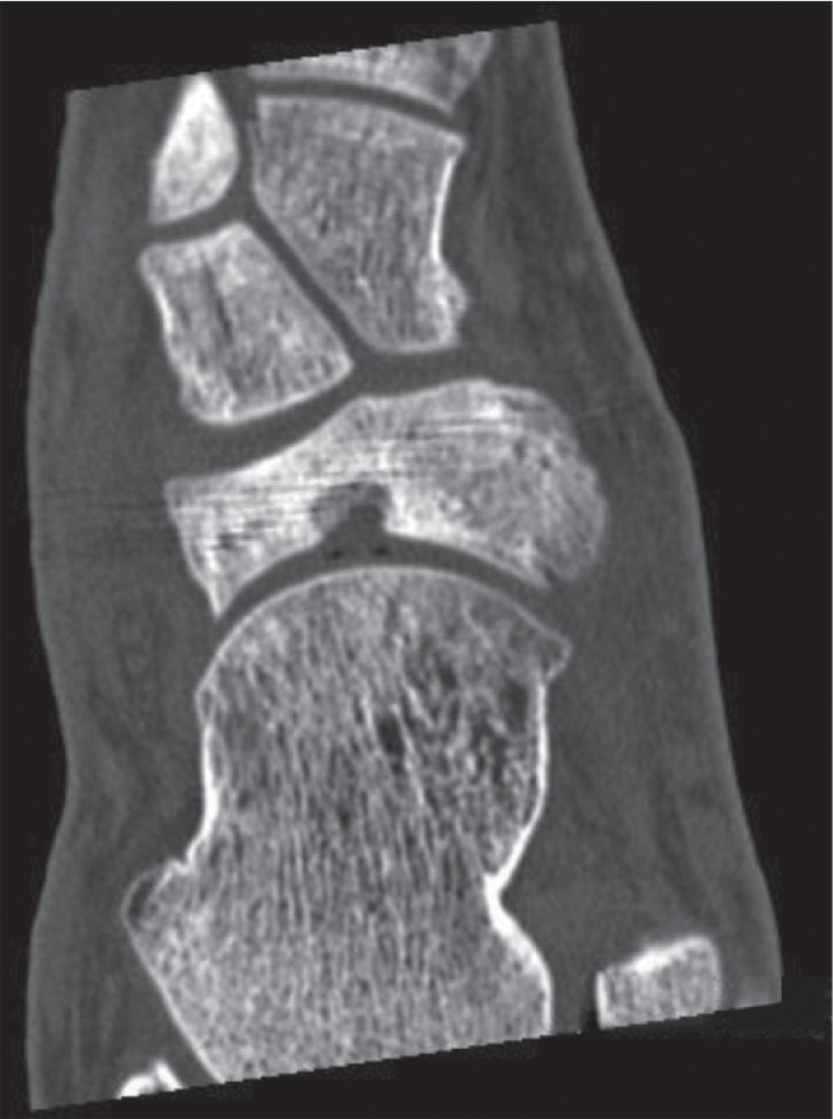 Fig. 47-11, An axial view of a computed tomography scan of patient who developed a medullary cyst after healing a navicular stress fracture. Note the sclerosis from the healed fracture around the cyst.