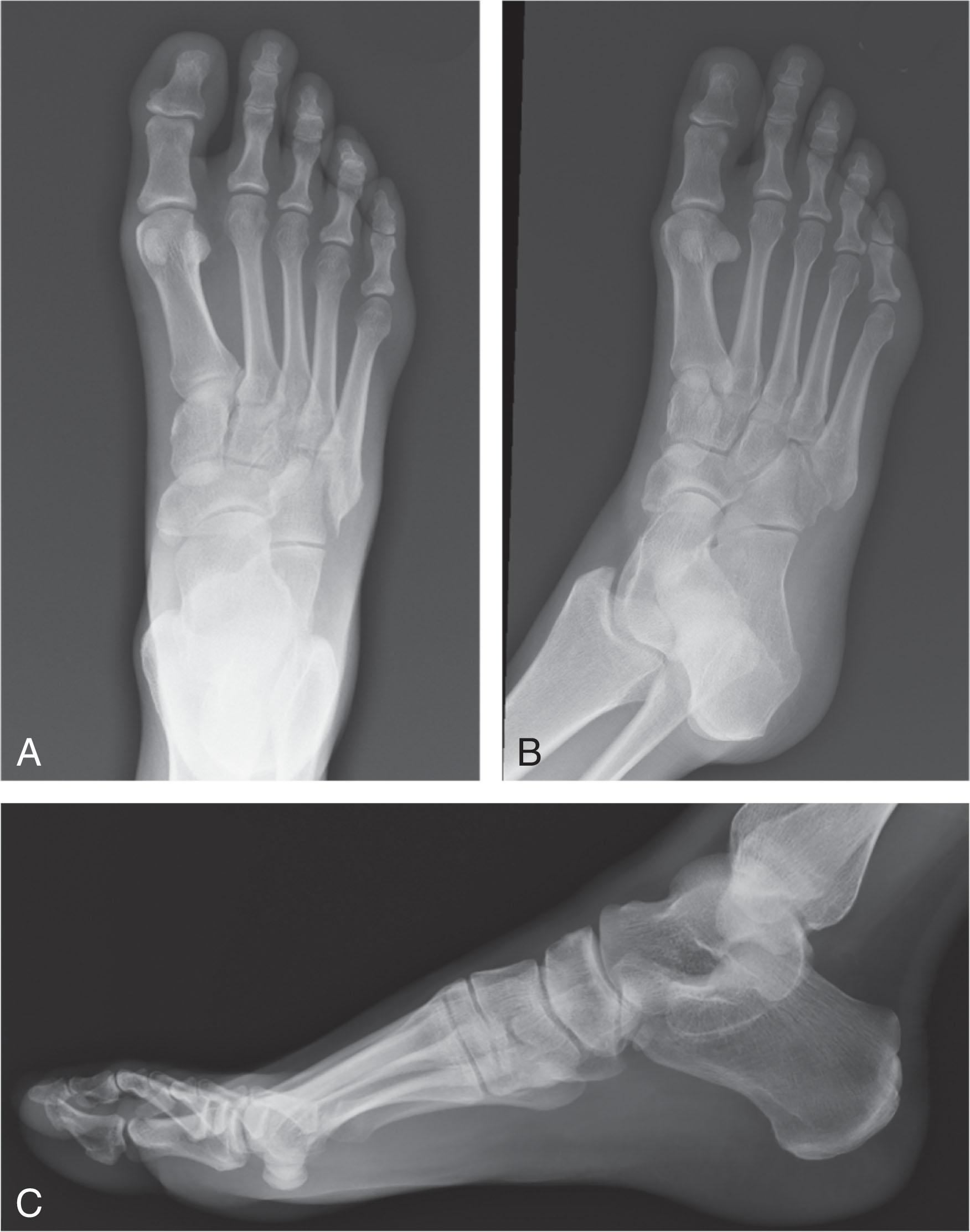 Fig. 47-12, A three-view radiographic view of the foot demonstrates a minimally displaced cuboid fracture.