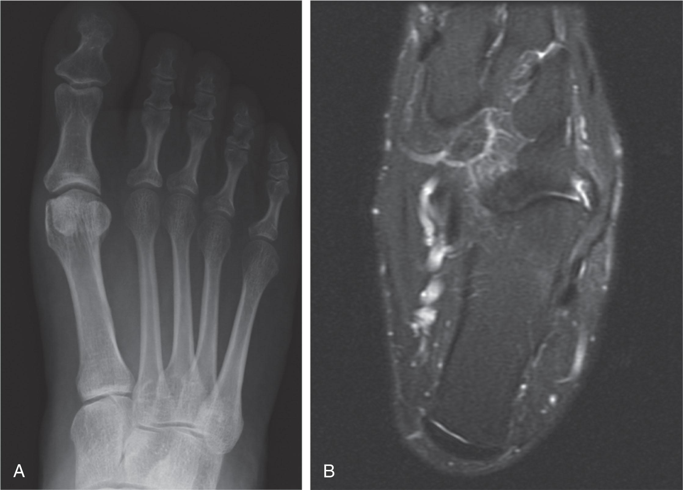 Fig. 47-13, A , A standing anteroposterior radiograph of a cuboid avulsion fracture. The avulsion fracture can be subtle, and patients with more distal tenderness upon palpation or ecchymosis after an “ankle sprain” may have an avulsion from the cuboid. B , A T2-weighted magnetic resonance image of the same patient with a cuboid avulsion fracture. Note the increased signal in the lateral cuboid between the cuboid and the avulsed fragment.